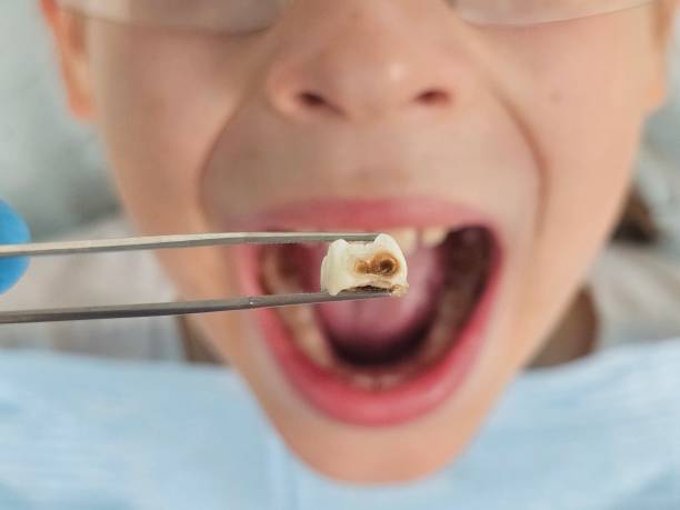 Best Emergency Wisdom Tooth Extraction in Bar Nunn, WY